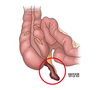 "충수염(맹장염), 항생제로도 치료 가능"