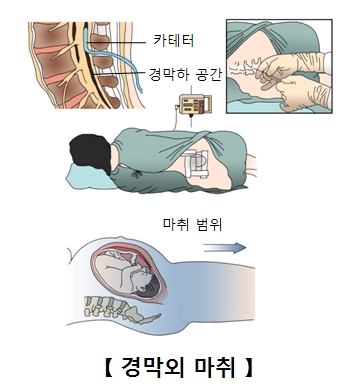 "경막외 마취 분만, 자녀 자폐증 위험↑"