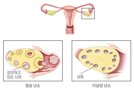 [명의에게 묻다] 난임 부르는 '다낭성난소증후군'…"생리불순이 첫 신호"