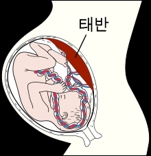 "엄마 알레르기 체질, 태반 통해 태아에 전달된다"