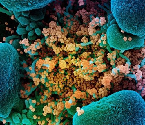 숨은 에이즈 바이러스의 RNA 생성, 보균자 생명 단축한다