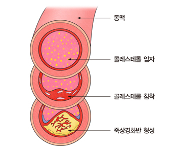 "고지혈증약 스타틴, 고령층에 효과 더 크다."