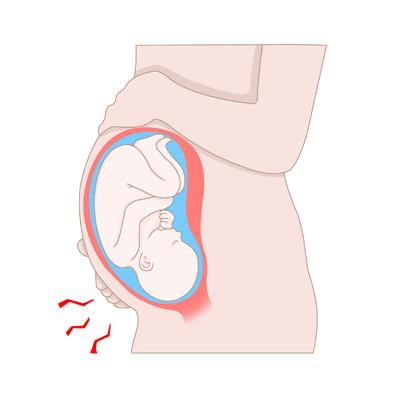 "28주 이전 조산 여성, 5~25세 사이 우울증 위험↑"