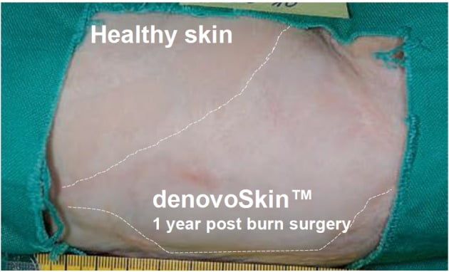 왼쪽이 건강한 피부고 오른쪽이 데네보스킨을 이식한 부위다. 두 부위의 경계가 거의 보이지 않는다. 상피, 진피층 모두 원래 피부 조직과 유사하다는 것이 연구를 통해 증명됐다.