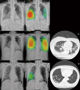 루닛 “폐 진단 보조 AI로 코로나19 환자 선별”