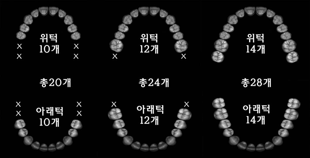 건강한 노년 위한 최소 치아 개수는…"위·아래 각각 10개"