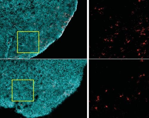 면역치료 후 '암 재발', 아예 싹 자르는 단백질 찾았다