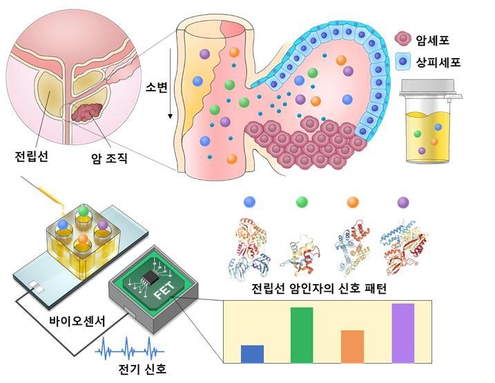 "'초고감도센서+AI' 소변검사로 20분 내 전립선암 정밀 진단"