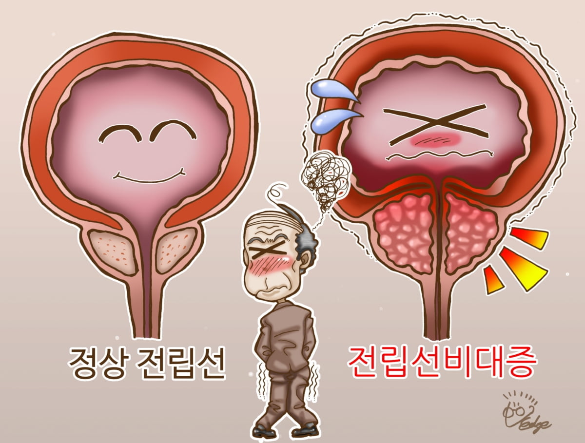 중년·노년 남성 밤잠 설치는 전립선비대증