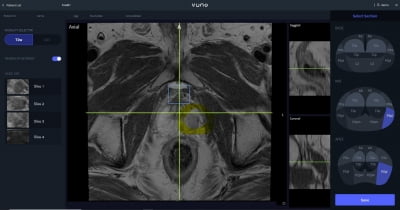 IPO 출격하는 뷰노, 전립선 영상 분석 소프트웨어 식약처 인증