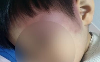 이혼한 아빠의 눈물…"엄마 남자친구가 아이 피멍들게 때렸다"