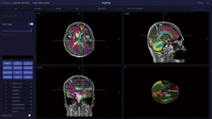서울아산-뷰노 구축한 AI, 뇌 MRI로 치매 예측 성능 입증