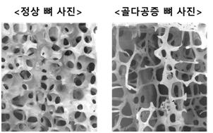 [김길원의 헬스노트] 낙상이 골절 부른다?…근본 원인은 '골다공증'