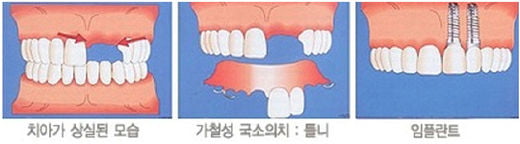 노인보철, 틀니보다 임플란트