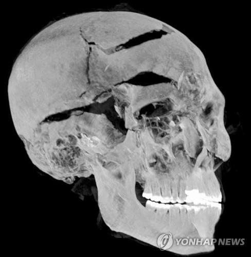 의학기술로 재구성한 3천600년전 이집트 파라오의 죽음