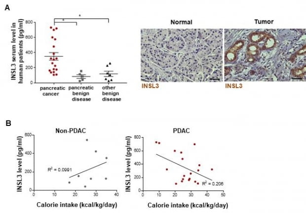 Proteins that cause eating disorders that reduce cancer patient survival