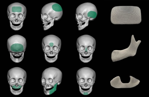 복합소재 두개골성형재료 샘플 예시 및 적용부위. 사진 제공=시지바이오
