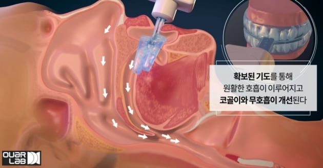 아워랩 “첫 국산 수면무호흡증 치료기 이달 판매”