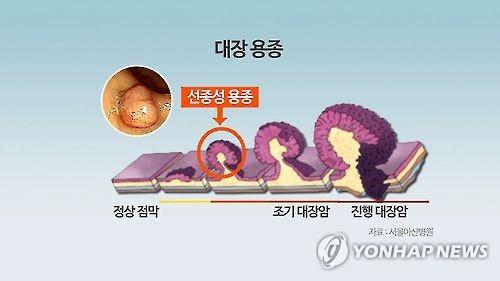 [김길원의 헬스노트] 대장암 부르는 습관…운동감소＞가공육·술·담배＞칼슘부족