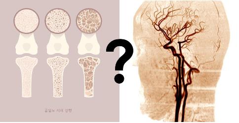 "뇌졸중 환자 61.7% 골밀도 저하…뼈 약해지면 뇌혈관도 위험"