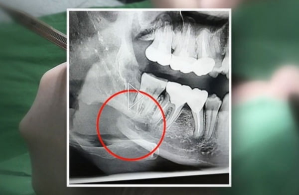 사랑니 뽑다가 턱뼈 부러뜨리고 모른 척…공포의 치과