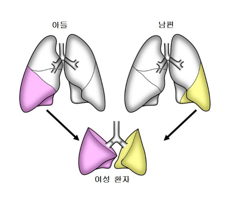 코로나 후유증 일본 여성에 남편·아들 폐 이식…세계 최초