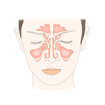 "부비동염(축농증), 뇌에도 영향"