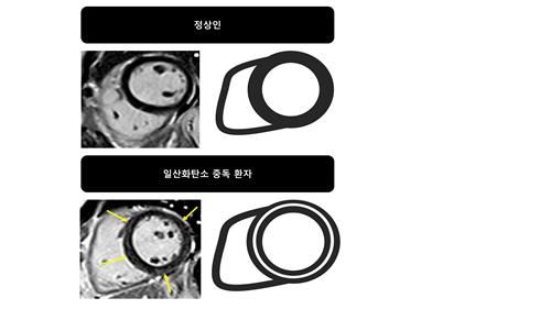 "일산화탄소 중독 환자 심장 손상, 저산소증 때문 아냐"