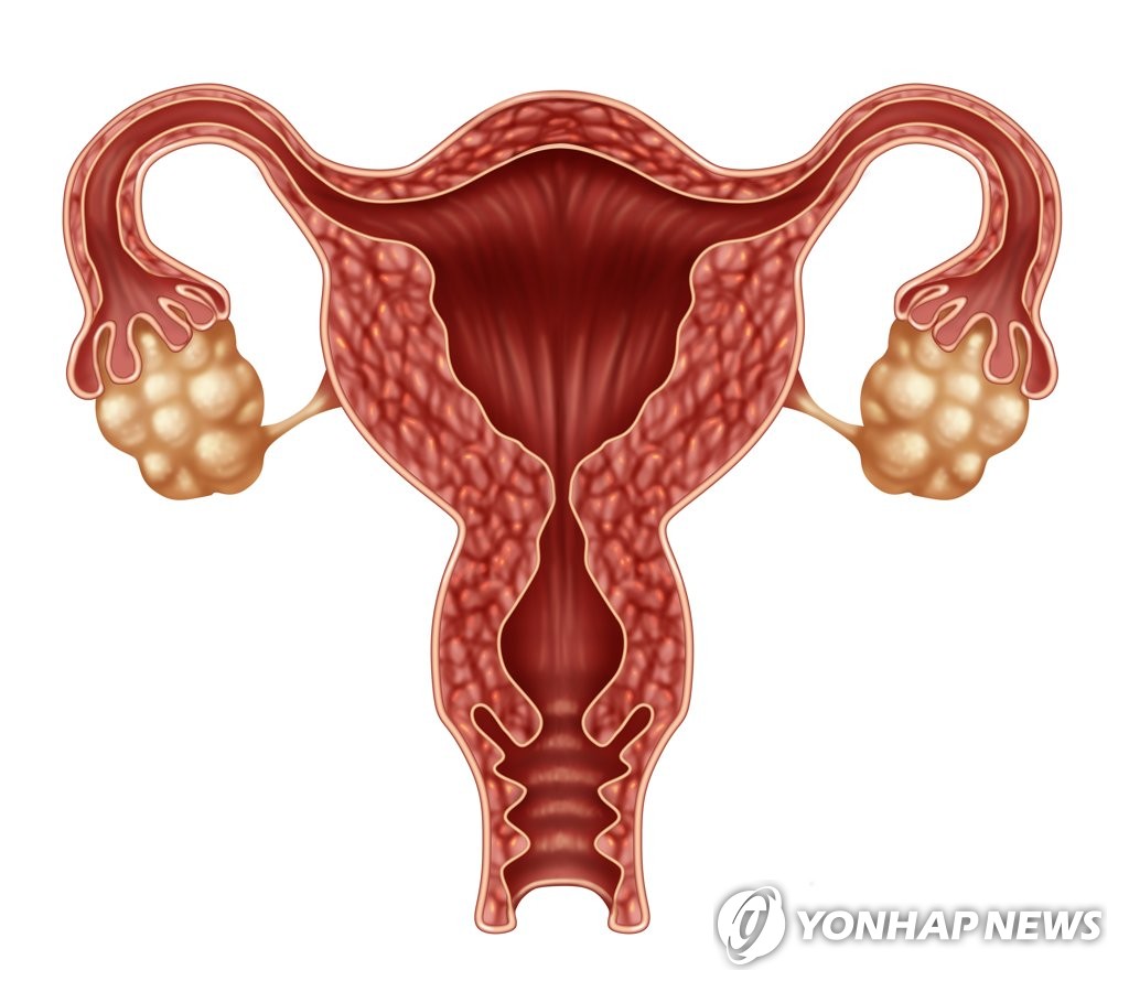 비만하지 않아도 다낭성 난소증후군 있으면 당뇨 위험 2배