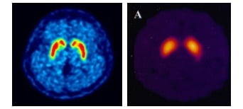 퓨쳐켐의 피디뷰(PET-CT)(좌), G사 경쟁약물(SPECT-CT)(우) 비교. 피디뷰를 통해 파킨슨병을 진단하는 지표, 도파민 운반체의 농도를 더 명확하게 확인할 수 있다. 제공=퓨쳐켐