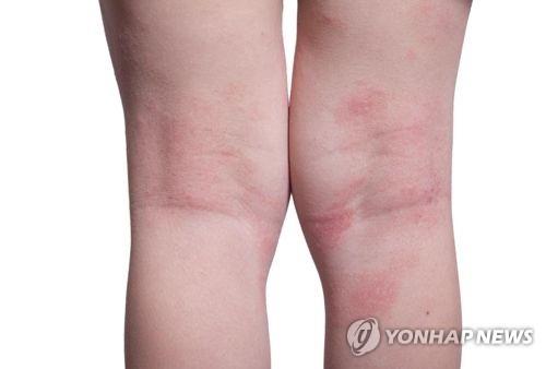 가려움 강도 측정하는 휴대용 센서 개발