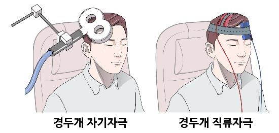 "귀에서 '삐~' 난치성 이명, 뇌에 전기자극 줘 치료 가능"