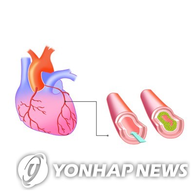 "40세 이전 조기폐경, 관상동맥 질환 위험↑"