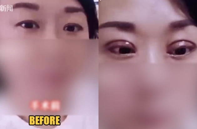 쌍꺼풀 수술에 실패한 중국 여성 진 씨. /사진=칸칸뉴스 캡쳐 