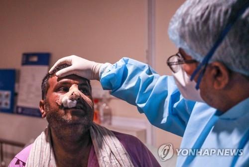 인도 '검은 곰팡이증' 급속 확산…2천100명 사망