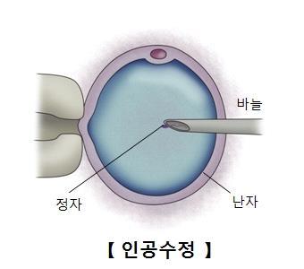 "배란 촉진제, 유방암 위험 없다"