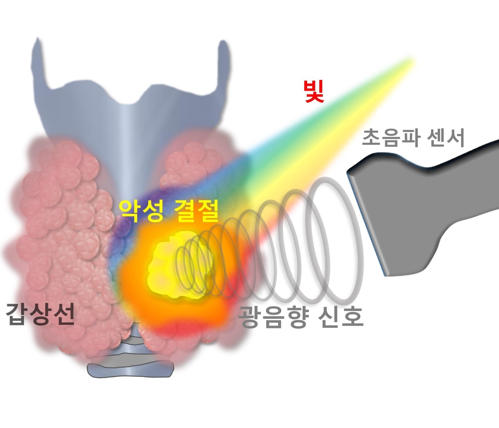 갑상선 암 인공지능 기술로 진단…"생체검사 줄일 수 있어"