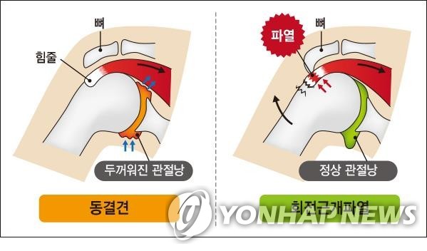 "오십견인 줄 알았더니"…어깨통증, 놔두면 좋아진다는 건 착각