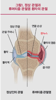 [Cover Story - part.1 Analysis] 자가면역질환은 왜 발생하는가