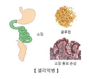 셀리악병 최초 치료제 개발