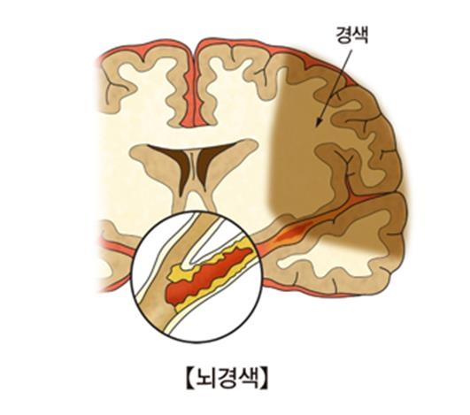 "뇌경색 실어증, 성악 듣기 도움된다"