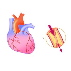 "안정형 협심증, 보존 치료로 충분"