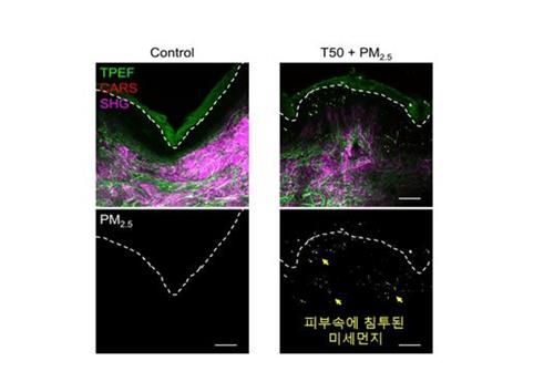 각질 손상된 아토피 피부, 미세먼지에 더 치명적…염증 악화