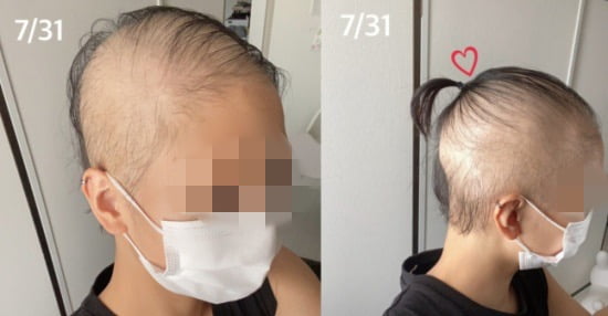 일본의 20대 여성이 모더나 백신 접종 후 탈모증에 걸렸다고 주장했다/사진=온라인 커뮤니티
