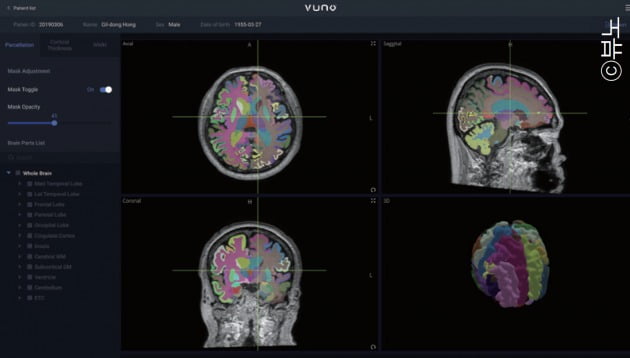 ‘뷰노메드 딥브레인’을 이용하면 MRI로 뇌 영역의 위축 정도를 파악할 수 있다. 