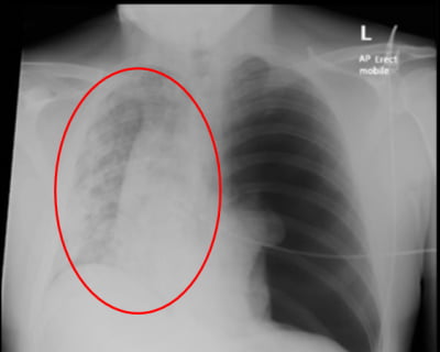 "폐가 완전 망가졌다"…코로나 환자 엑스레이 사진에 '경악'