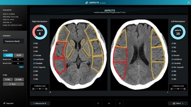 휴런 "뇌경색 지수 자동산출 AI, 국내 임상 승인"