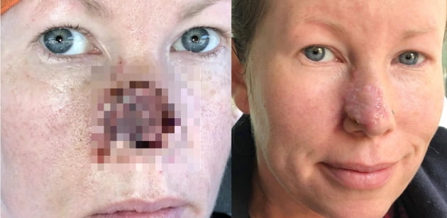 멜리사 파이프의 수술 후에 모습(왼쪽). 코 피부가 회복 중인 모습(오른쪽)/사진=멜리사 파이프 SNS 