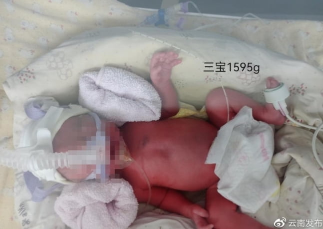 코로나 감염 中 임산부 세쌍둥이 출산…아이 모두 `음성`