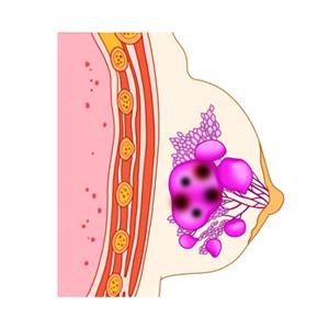 "노년기 치밀 유방, 유방암 위험 40%↑"